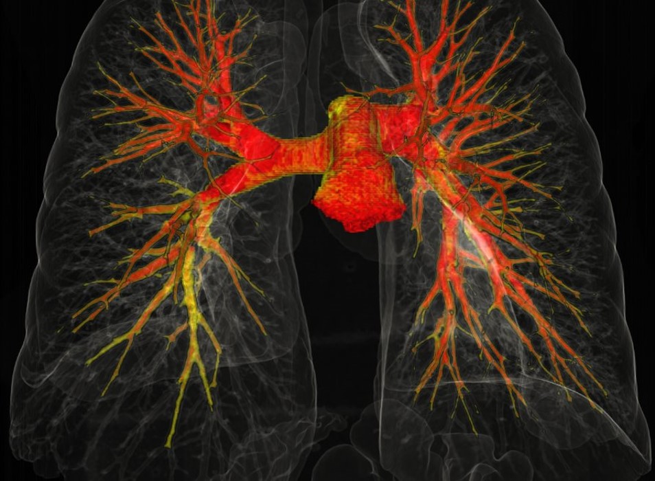 Pós-Processamento de Imagem - Dissecção aorta e TEP_ (1)