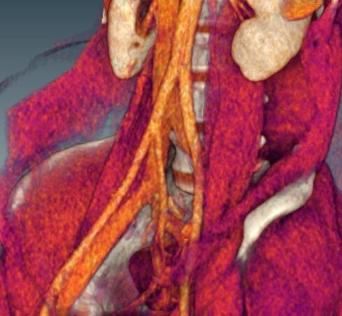 Pós-Processamento de Imagem - Dissecção aorta e venografia pélvica (1)